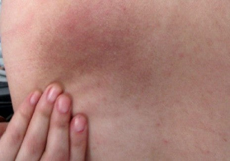 Under boob rash (pics included)